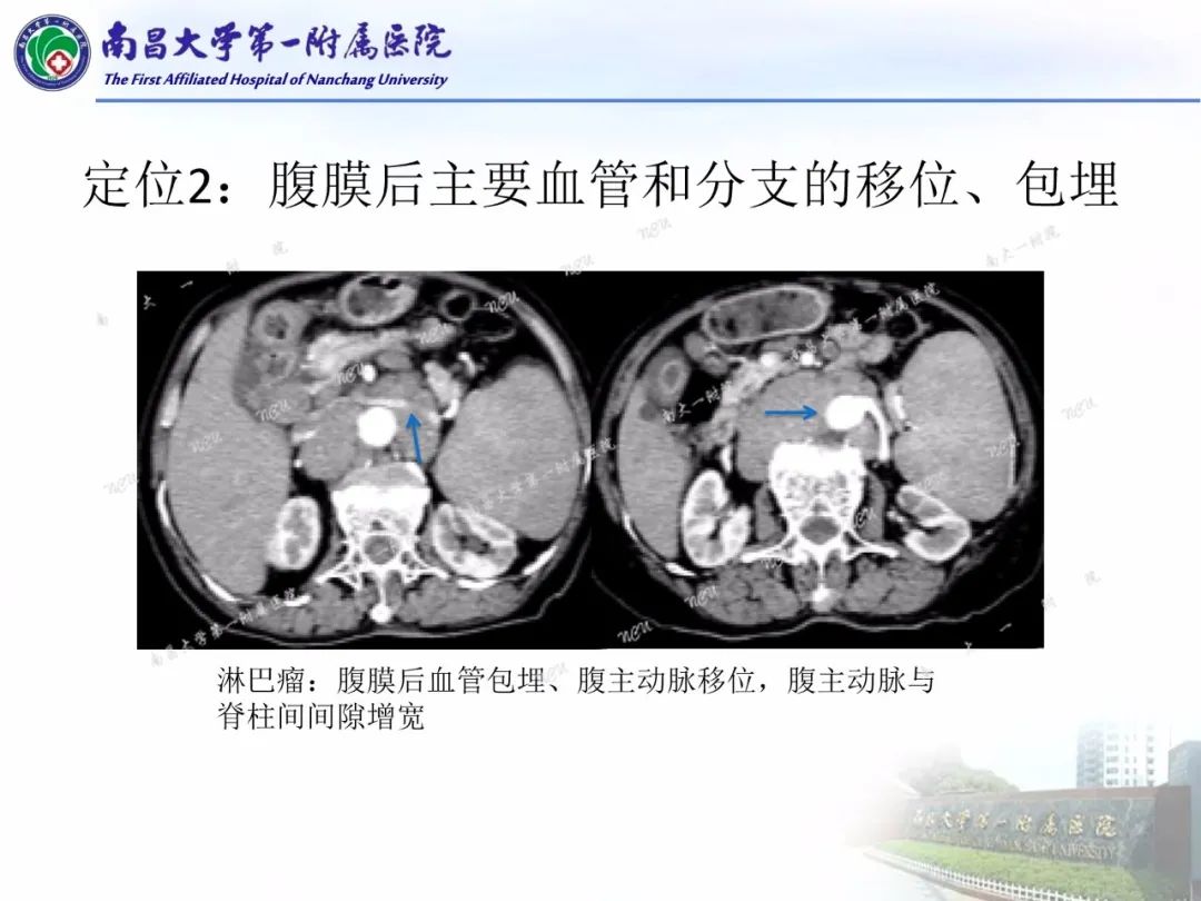 影像PPT - 【PPT】常见腹膜后肿瘤的诊断及鉴别诊断-70