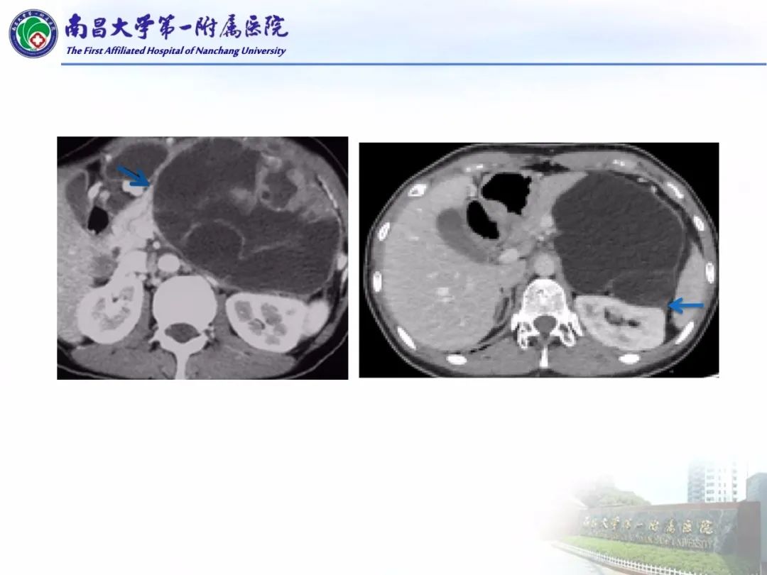 影像PPT - 【PPT】常见腹膜后肿瘤的诊断及鉴别诊断-73