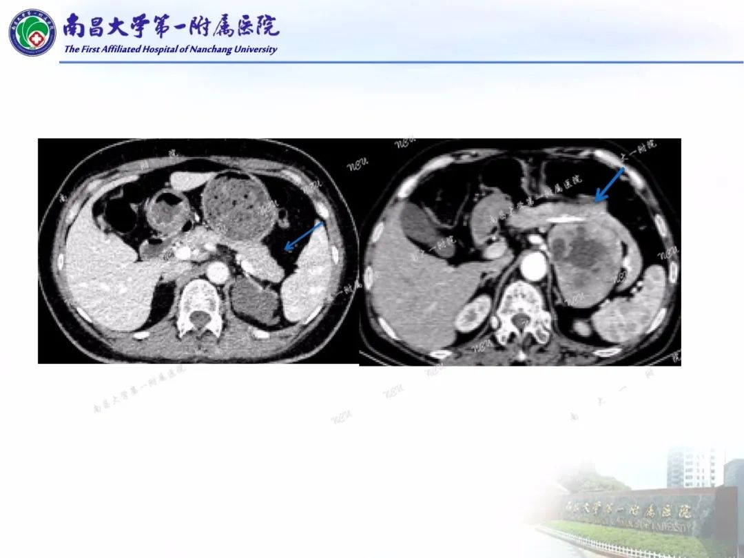 影像PPT - 【PPT】常见腹膜后肿瘤的诊断及鉴别诊断-75