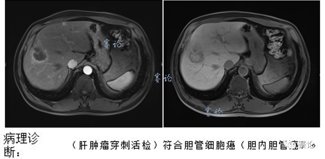 影像PPT - 肝内胆管细胞癌影像学诊断及鉴别诊断-6 影像PPT - 肝内胆管细胞癌影像学诊断及鉴别诊断-6