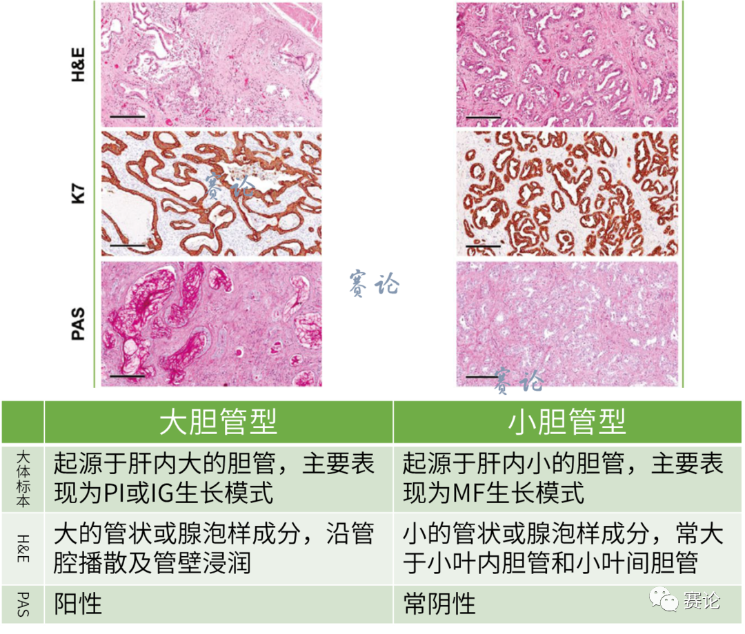 影像PPT - 肝内胆管细胞癌影像学诊断及鉴别诊断-25 影像PPT - 肝内胆管细胞癌影像学诊断及鉴别诊断-25