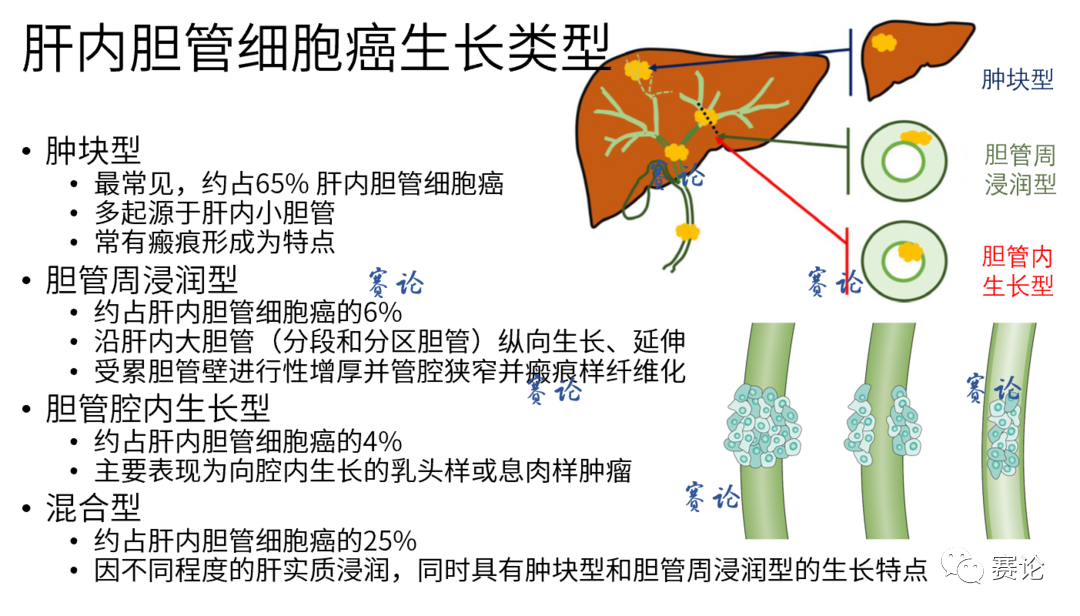 影像PPT - 肝内胆管细胞癌影像学诊断及鉴别诊断-27 影像PPT - 肝内胆管细胞癌影像学诊断及鉴别诊断-27