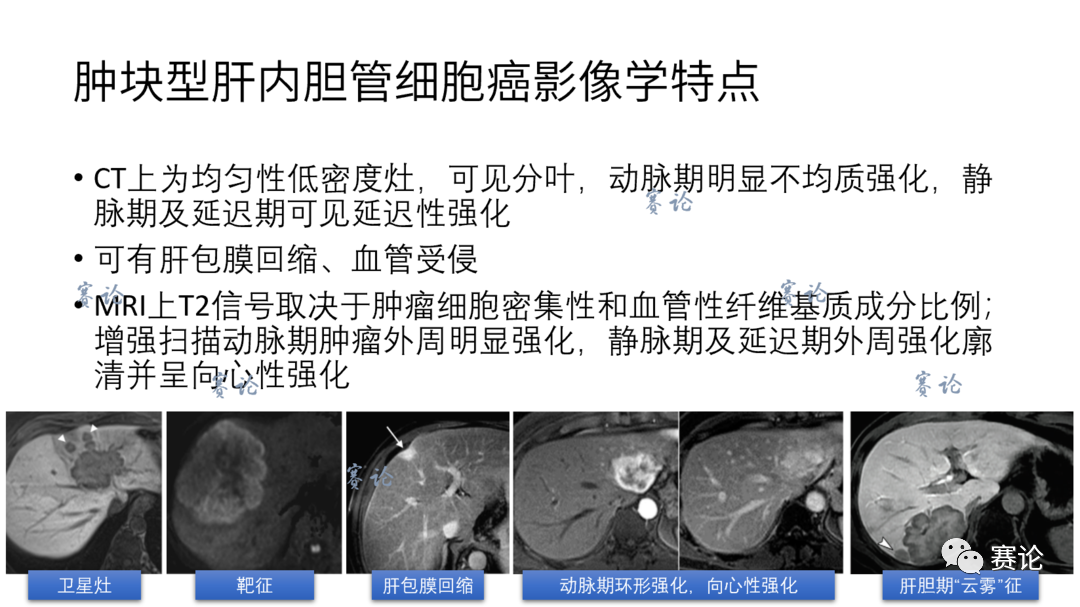 影像PPT - 肝内胆管细胞癌影像学诊断及鉴别诊断-36 影像PPT - 肝内胆管细胞癌影像学诊断及鉴别诊断-36