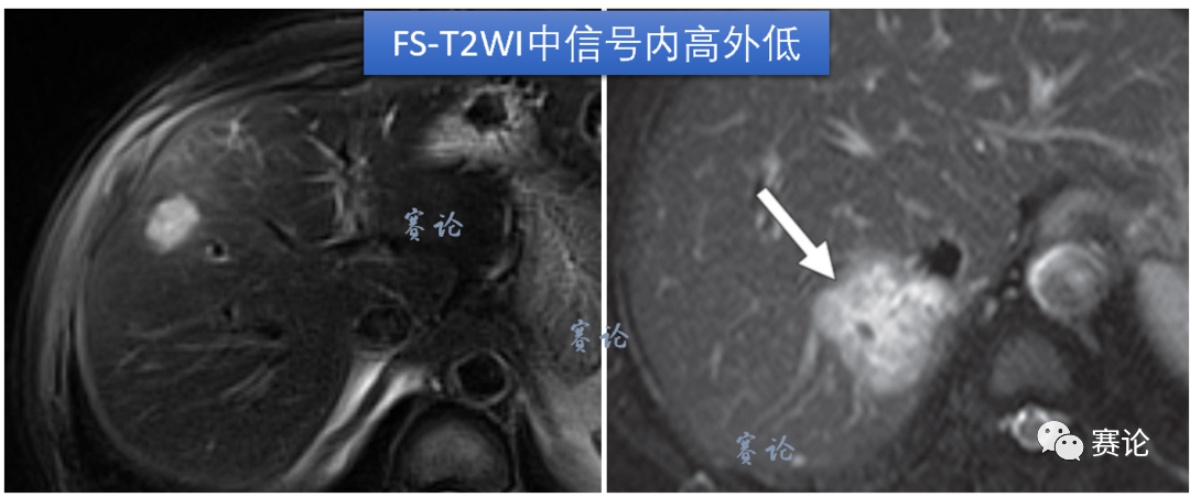 影像PPT - 肝内胆管细胞癌影像学诊断及鉴别诊断-37 影像PPT - 肝内胆管细胞癌影像学诊断及鉴别诊断-37