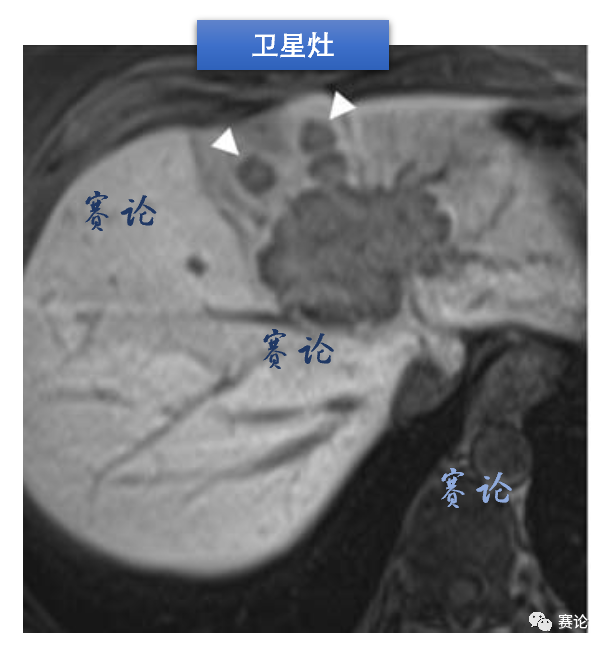 影像PPT - 肝内胆管细胞癌影像学诊断及鉴别诊断-39 影像PPT - 肝内胆管细胞癌影像学诊断及鉴别诊断-39