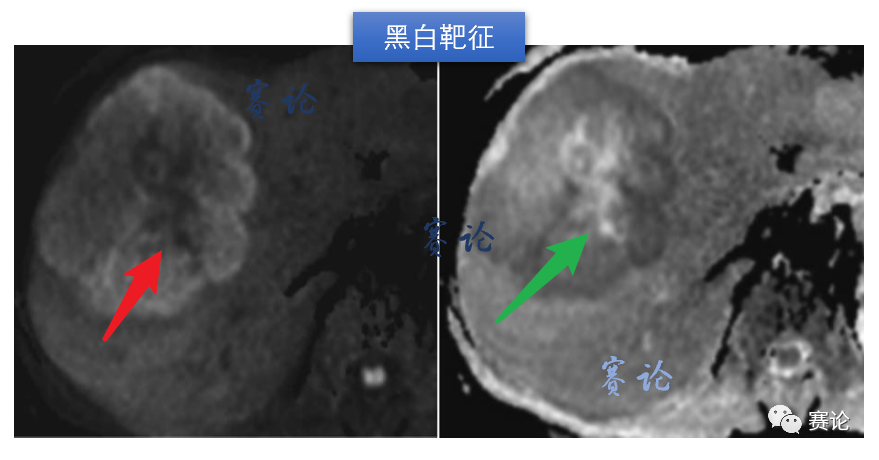 影像PPT - 肝内胆管细胞癌影像学诊断及鉴别诊断-41 影像PPT - 肝内胆管细胞癌影像学诊断及鉴别诊断-41