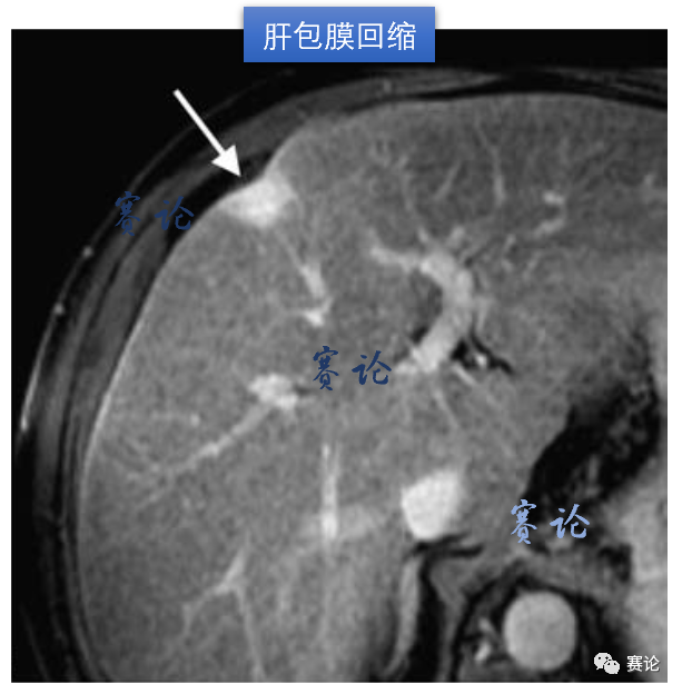 影像PPT - 肝内胆管细胞癌影像学诊断及鉴别诊断-43 影像PPT - 肝内胆管细胞癌影像学诊断及鉴别诊断-43