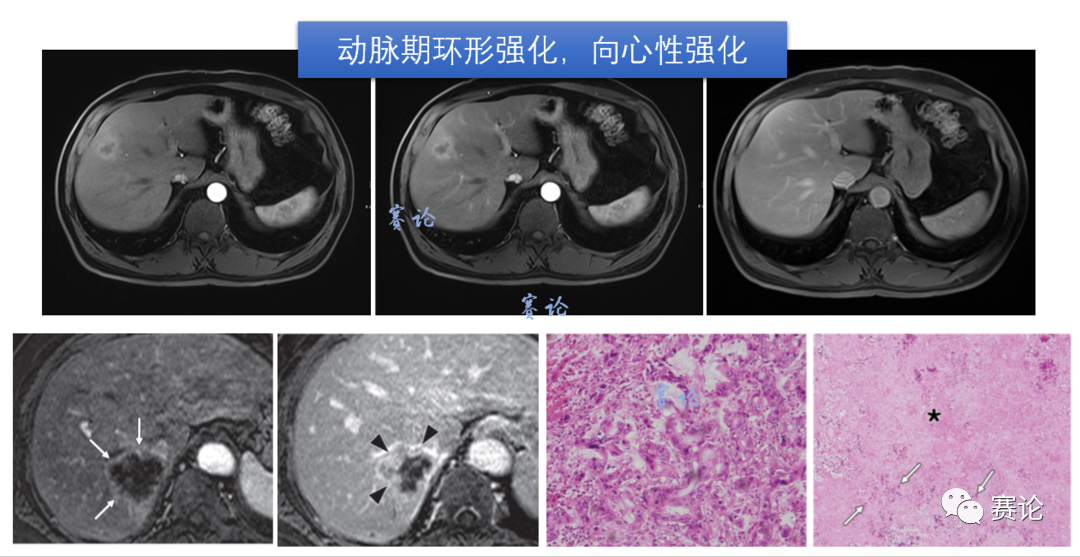 影像PPT - 肝内胆管细胞癌影像学诊断及鉴别诊断-45 影像PPT - 肝内胆管细胞癌影像学诊断及鉴别诊断-45