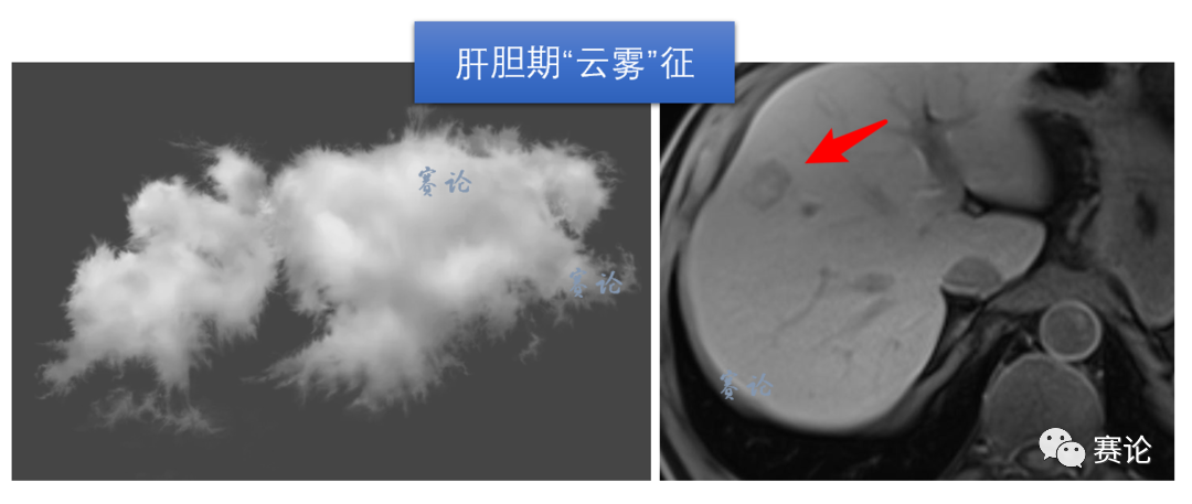 影像PPT - 肝内胆管细胞癌影像学诊断及鉴别诊断-47 影像PPT - 肝内胆管细胞癌影像学诊断及鉴别诊断-47
