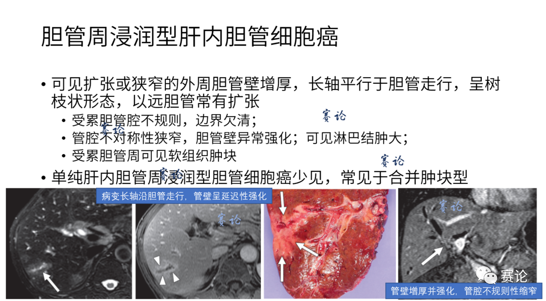 影像PPT - 肝内胆管细胞癌影像学诊断及鉴别诊断-49 影像PPT - 肝内胆管细胞癌影像学诊断及鉴别诊断-49