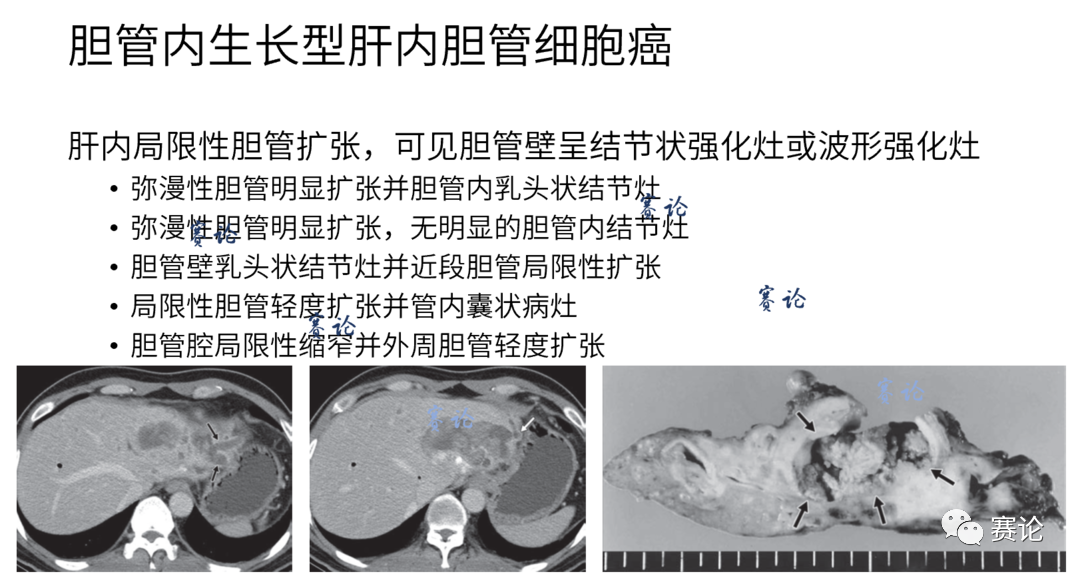 影像PPT - 肝内胆管细胞癌影像学诊断及鉴别诊断-50 影像PPT - 肝内胆管细胞癌影像学诊断及鉴别诊断-50