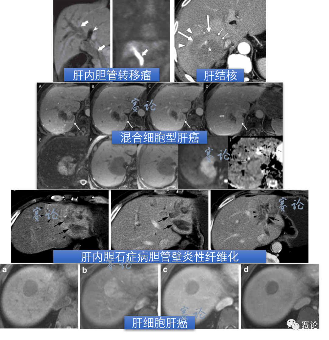 影像PPT - 肝内胆管细胞癌影像学诊断及鉴别诊断-52 影像PPT - 肝内胆管细胞癌影像学诊断及鉴别诊断-52