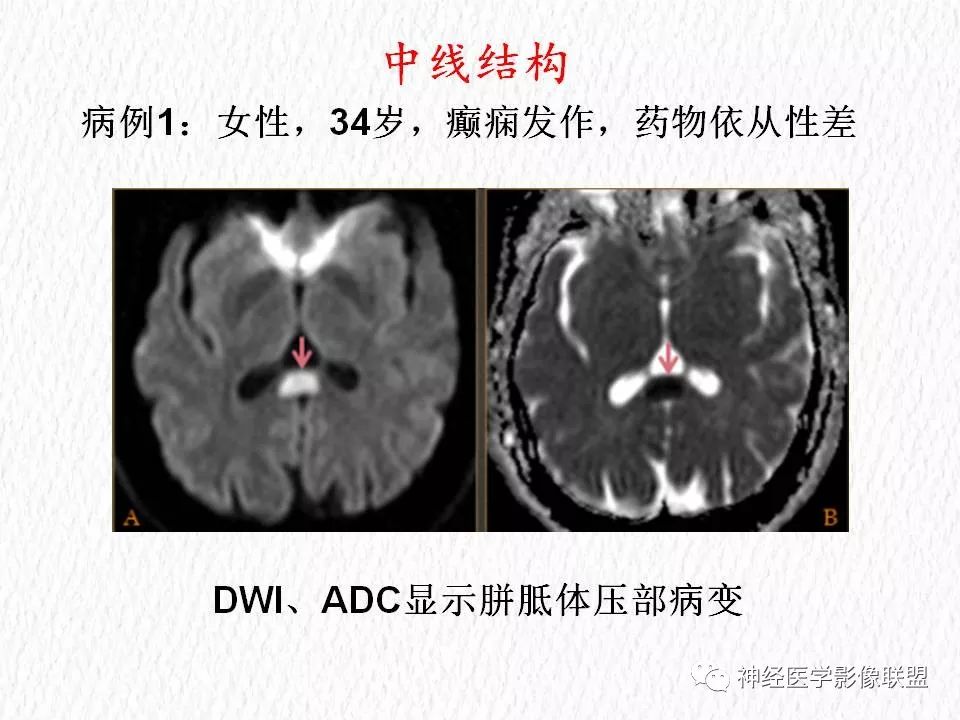 影像PPT - 【PPT】对称性DWI异常信号在非缺血性脑疾病中的影像诊断-2