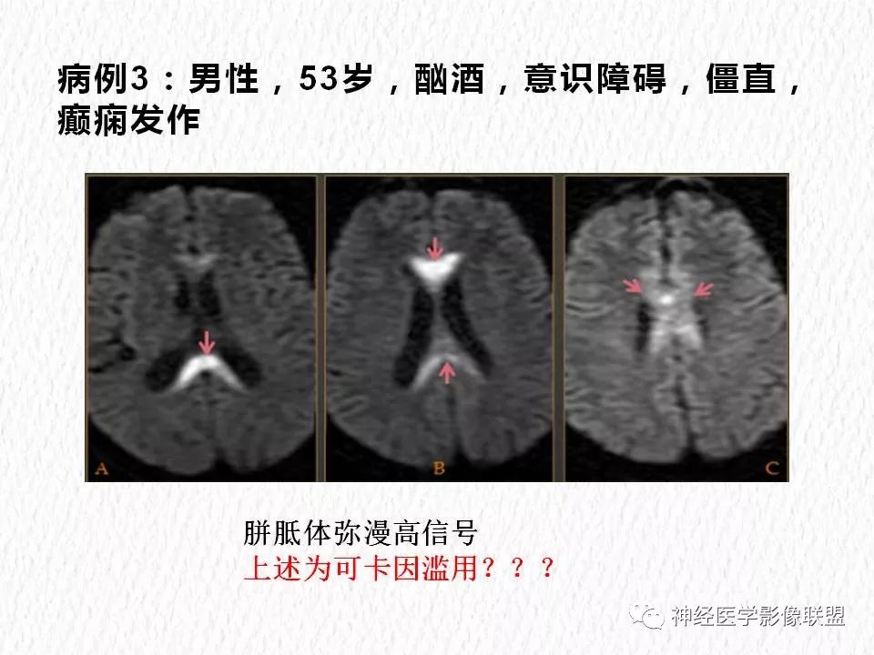 影像PPT - 【PPT】对称性DWI异常信号在非缺血性脑疾病中的影像诊断-6
