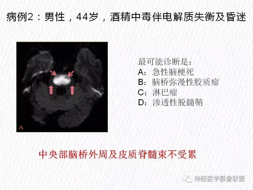 影像PPT - 【PPT】对称性DWI异常信号在非缺血性脑疾病中的影像诊断-4