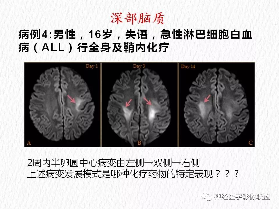 影像PPT - 【PPT】对称性DWI异常信号在非缺血性脑疾病中的影像诊断-8