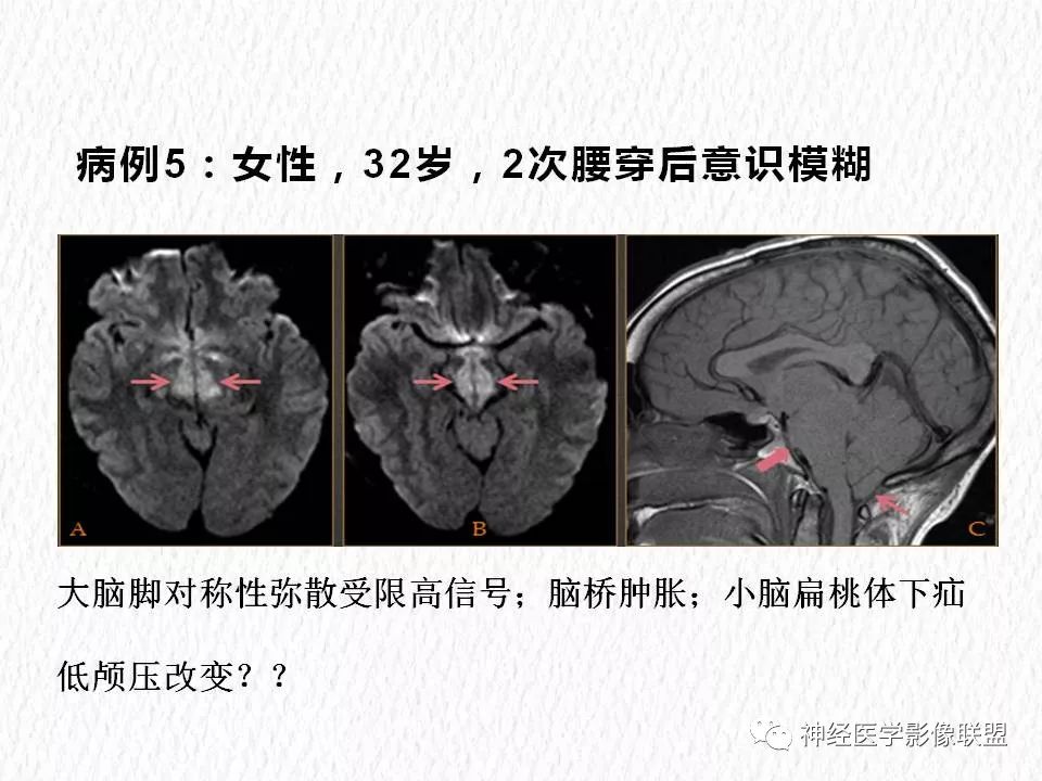 影像PPT - 【PPT】对称性DWI异常信号在非缺血性脑疾病中的影像诊断-10