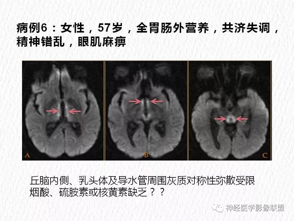 影像PPT - 【PPT】对称性DWI异常信号在非缺血性脑疾病中的影像诊断-12