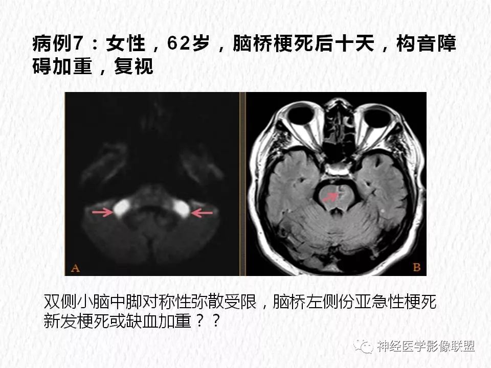 影像PPT - 【PPT】对称性DWI异常信号在非缺血性脑疾病中的影像诊断-14