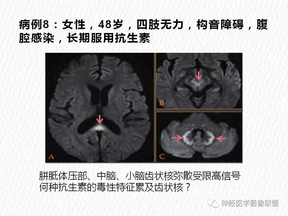 影像PPT - 【PPT】对称性DWI异常信号在非缺血性脑疾病中的影像诊断-16