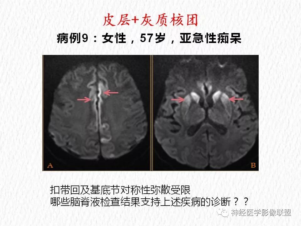 影像PPT - 【PPT】对称性DWI异常信号在非缺血性脑疾病中的影像诊断-18