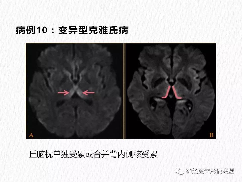 影像PPT - 【PPT】对称性DWI异常信号在非缺血性脑疾病中的影像诊断-20