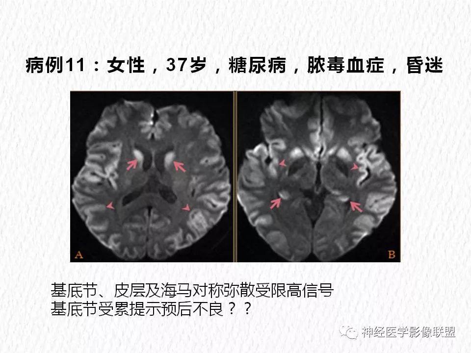 影像PPT - 【PPT】对称性DWI异常信号在非缺血性脑疾病中的影像诊断-21