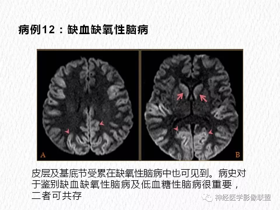 影像PPT - 【PPT】对称性DWI异常信号在非缺血性脑疾病中的影像诊断-23