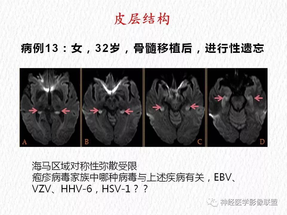影像PPT - 【PPT】对称性DWI异常信号在非缺血性脑疾病中的影像诊断-24