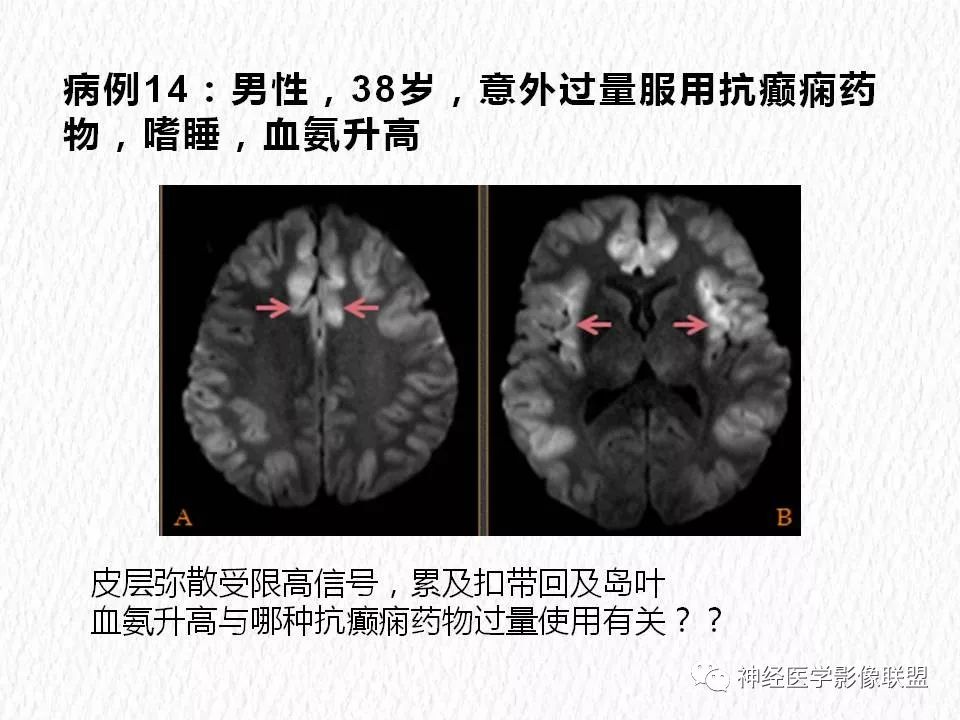 影像PPT - 【PPT】对称性DWI异常信号在非缺血性脑疾病中的影像诊断-26