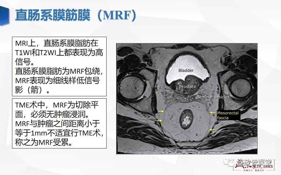 影像PPT - 【PPT】直肠癌术前MR分期-11