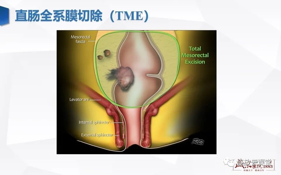 影像PPT - 【PPT】直肠癌术前MR分期-14