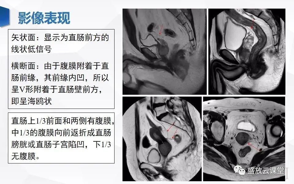 影像PPT - 【PPT】直肠癌术前MR分期-10