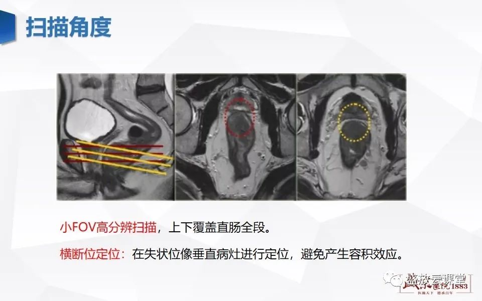 影像PPT - 【PPT】直肠癌术前MR分期-16