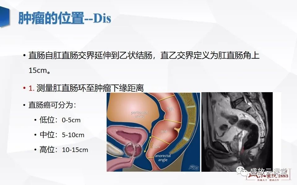 影像PPT - 【PPT】直肠癌术前MR分期-19