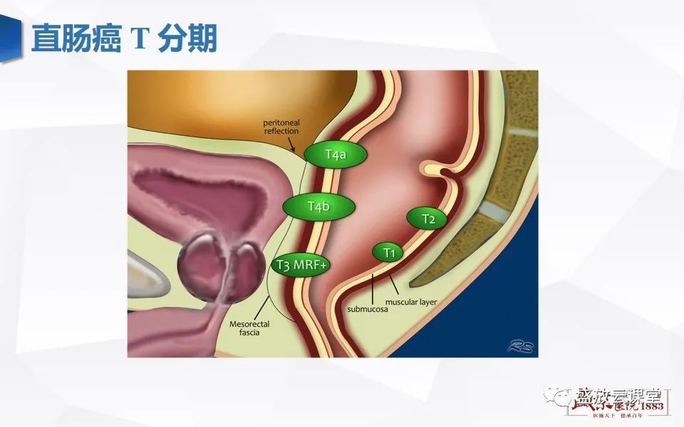 影像PPT - 【PPT】直肠癌术前MR分期-25