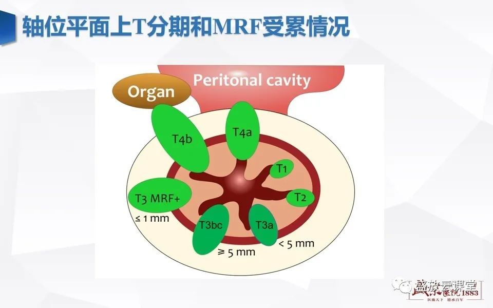 影像PPT - 【PPT】直肠癌术前MR分期-26