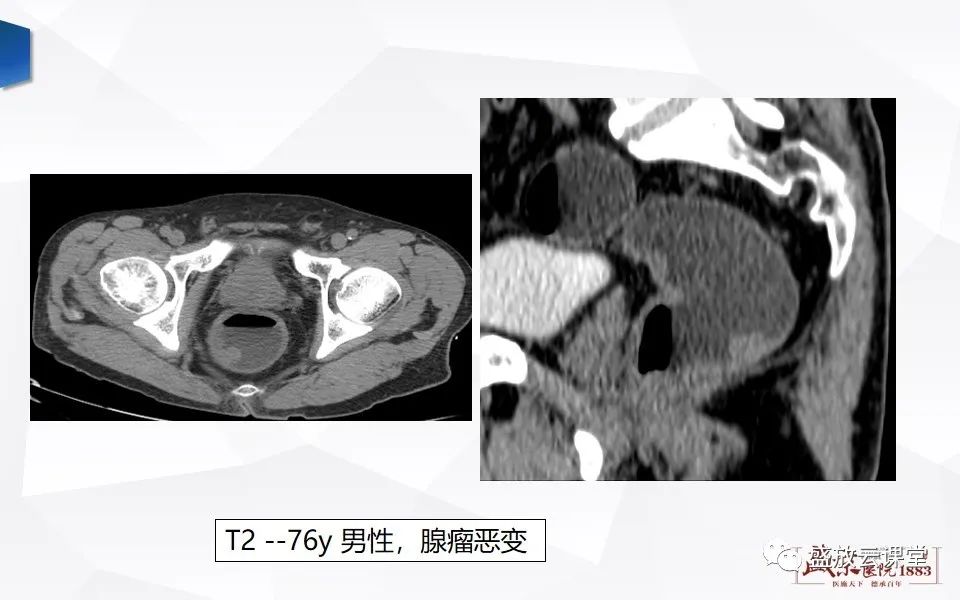 影像PPT - 【PPT】直肠癌术前MR分期-30