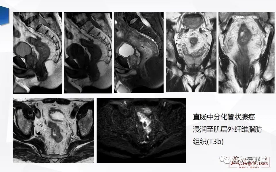 影像PPT - 【PPT】直肠癌术前MR分期-33