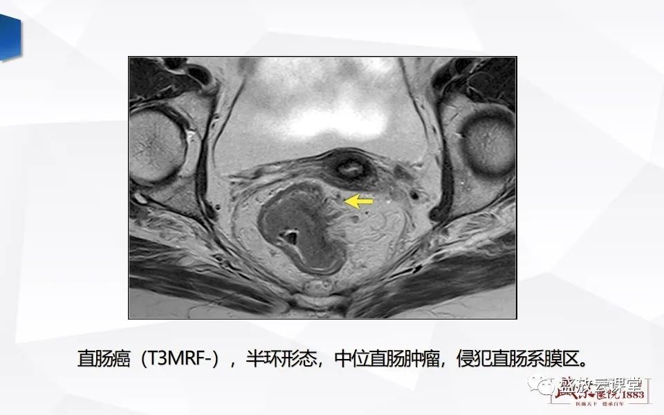 影像PPT - 【PPT】直肠癌术前MR分期-35