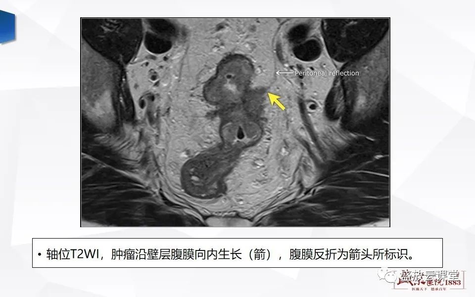 影像PPT - 【PPT】直肠癌术前MR分期-38