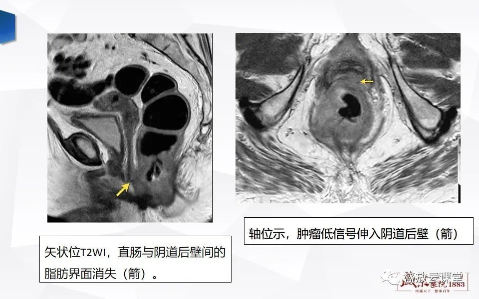 影像PPT - 【PPT】直肠癌术前MR分期-40