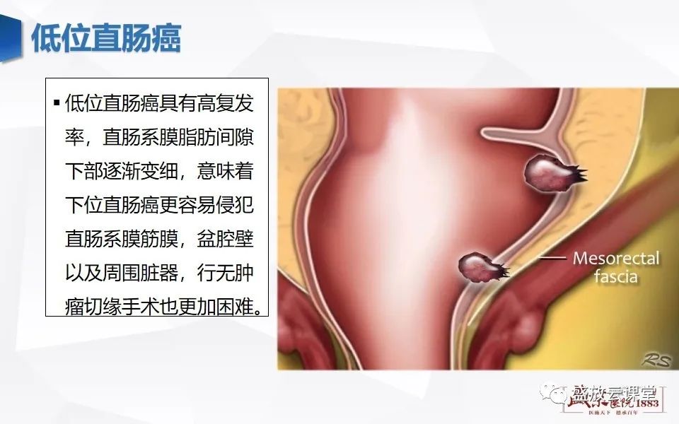影像PPT - 【PPT】直肠癌术前MR分期-43