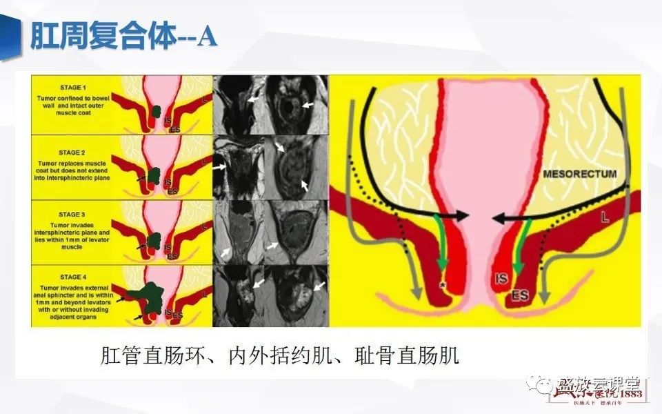 影像PPT - 【PPT】直肠癌术前MR分期-45