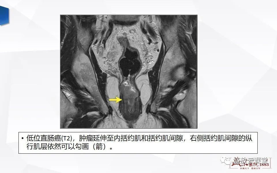 影像PPT - 【PPT】直肠癌术前MR分期-46