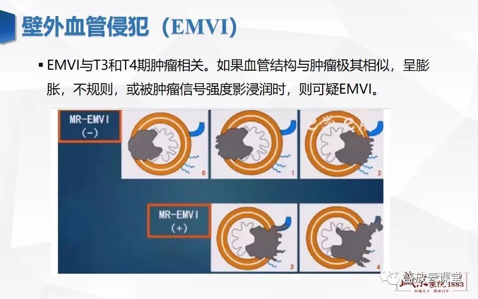 影像PPT - 【PPT】直肠癌术前MR分期-48