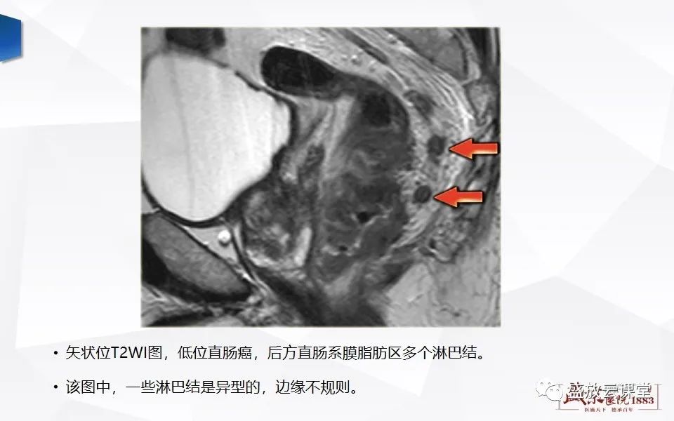 影像PPT - 【PPT】直肠癌术前MR分期-52