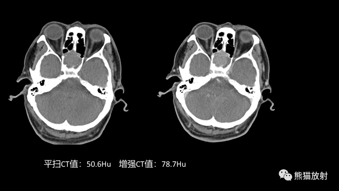 影像PPT - 【病例】鼻窦癌 VS 颅面骨骨化性纤维瘤-9
