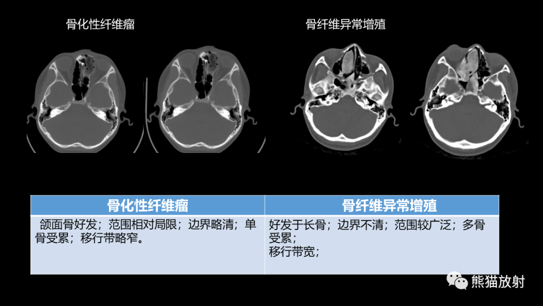 影像PPT - 【病例】鼻窦癌 VS 颅面骨骨化性纤维瘤-28