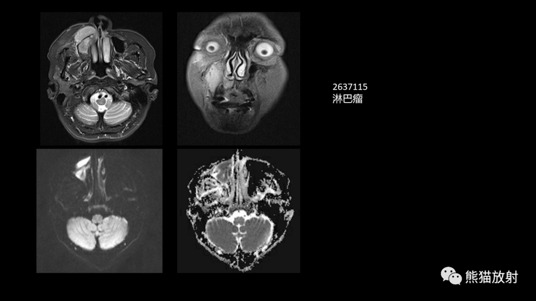 影像PPT - 【病例】鼻窦癌 VS 颅面骨骨化性纤维瘤-35